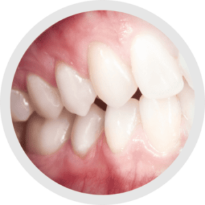 Nuovi occhiali ingrandenti prismatici 5.8X Admetec