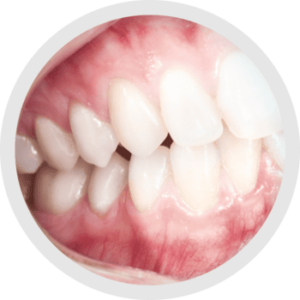 Nuovi occhiali ingrandenti prismatici 4.8X Admetec