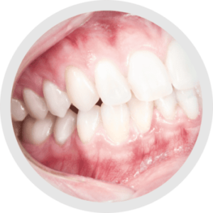 Nuovi occhiali ingrandenti prismatici 3.8X Admetec